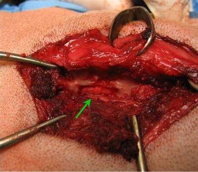 Operace výhřezu meziobratlové ploténky - hemilaminektomie