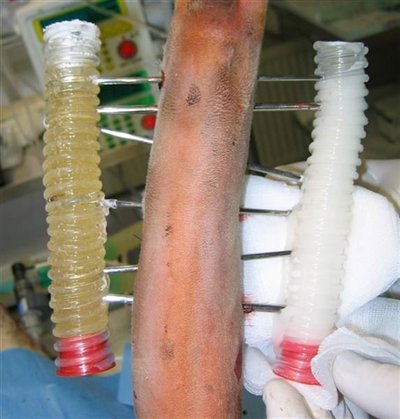 Zevní fixace fraktury radia a ulny (= zlomeniny obou kostí předloktí)