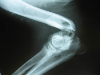 Zlomenina pažní kosti v loketním kloubu